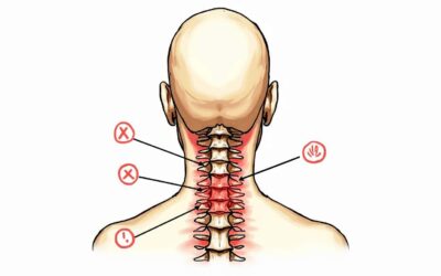Cervicalgia: qué debes saber
